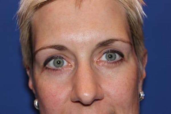 Eyelid Surgery Before & After Gallery - Patient 1309987 - Image 2