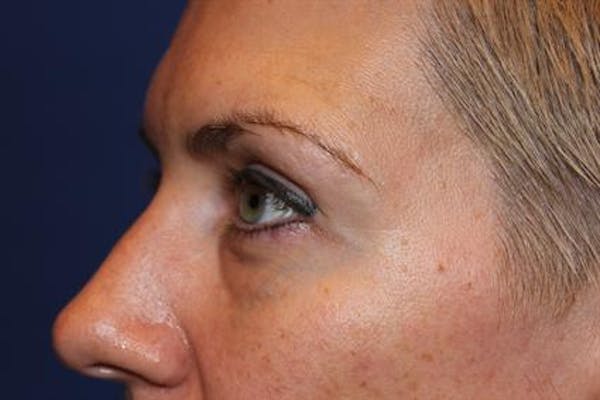 Eyelid Surgery Before & After Gallery - Patient 1309987 - Image 3