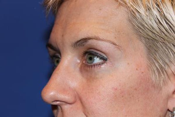 Eyelid Surgery Before & After Gallery - Patient 1309987 - Image 4
