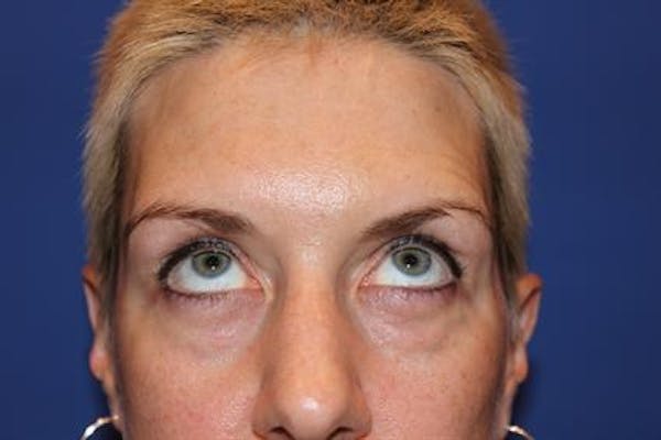 Eyelid Surgery Before & After Gallery - Patient 1309987 - Image 5