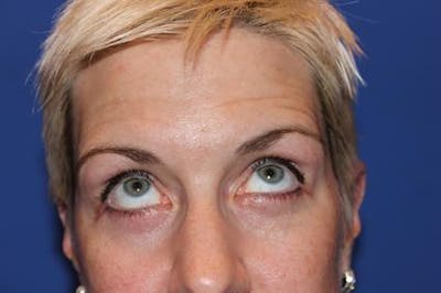 Eyelid Surgery Before & After Gallery - Patient 1309987 - Image 6