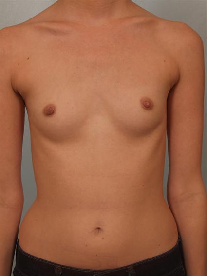 Before image of Breast Augmentation in Beverly Hills by Dr. Cohen.