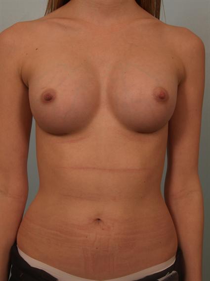 Image2 - Before and after image of Breast Augmentation by Dr. Cohen.