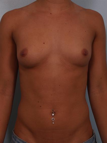 Before image of Breast Augmentation in Beverly Hills by Dr. Cohen.