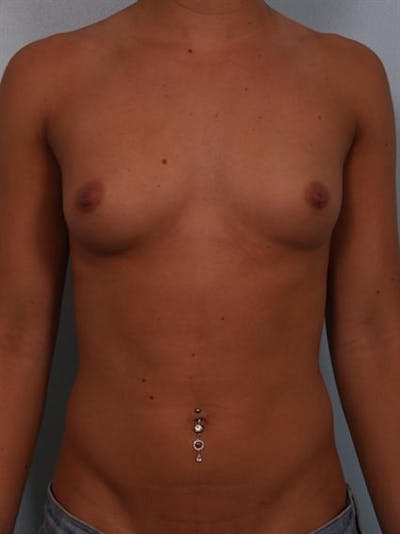 Breast Augmentation Before & After Gallery - Patient 1309996 - Image 1