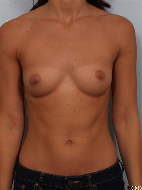 Breast Augmentation Before & After Gallery - Patient 1309997 - Image 1