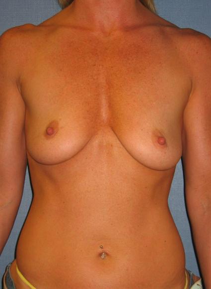 Before image of Breast Augmentation in Beverly Hills by Dr. Cohen.