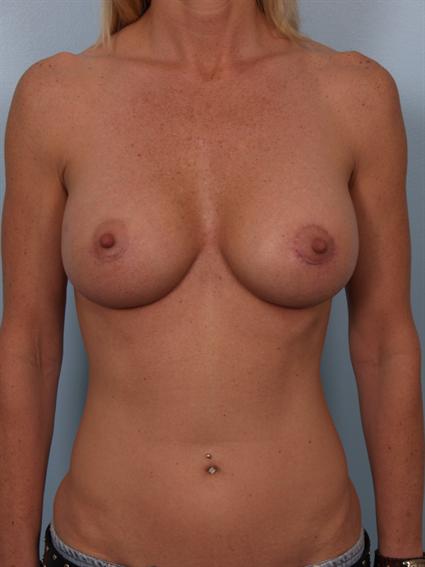 Image10 - Before and after image of Breast Augmentation by Dr. Cohen.