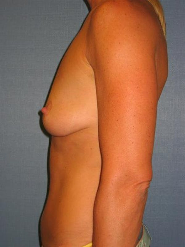 Breast Augmentation Before & After Gallery - Patient 1310000 - Image 3