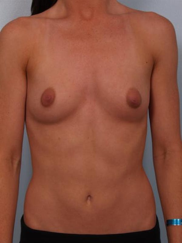 Breast Augmentation Gallery - Patient 1310002 - Image 1