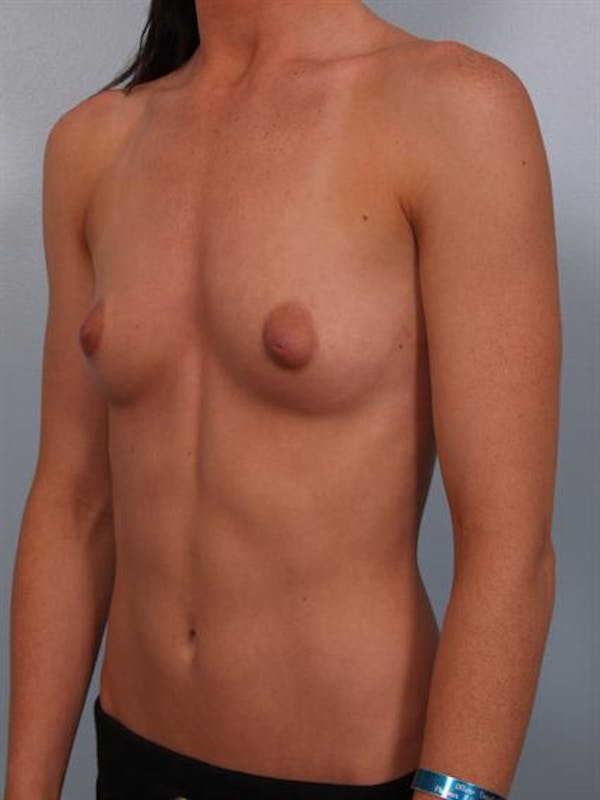Breast Augmentation Before & After Gallery - Patient 1310002 - Image 3