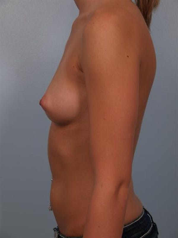Breast Augmentation Before & After Gallery - Patient 1310003 - Image 5