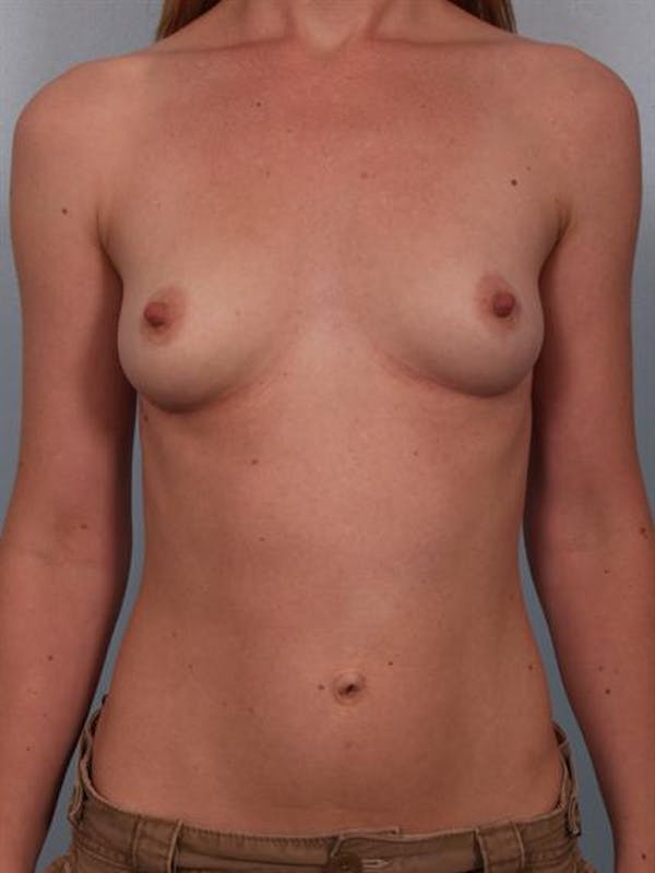 Breast Augmentation Before & After Gallery - Patient 1310012 - Image 3