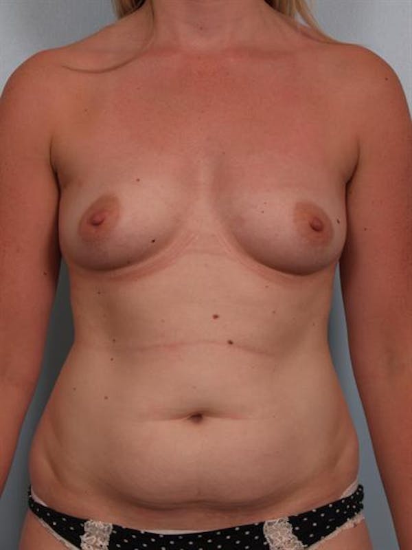 Breast Augmentation Before & After Gallery - Patient 1310016 - Image 1