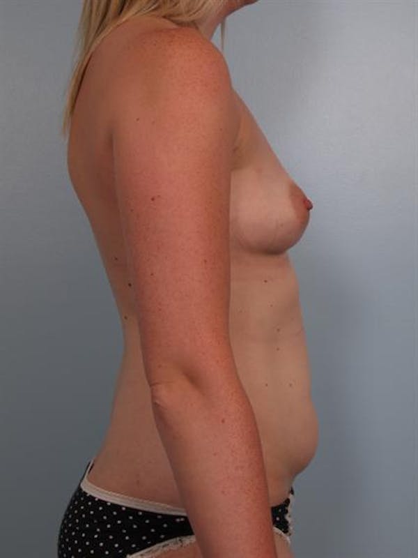 Breast Augmentation Before & After Gallery - Patient 1310016 - Image 3
