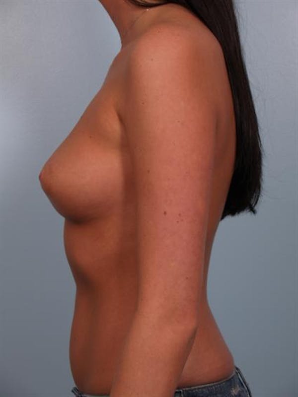 Breast Augmentation Before & After Gallery - Patient 1310018 - Image 1