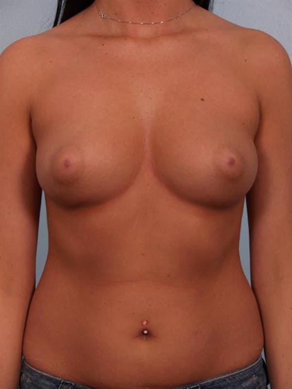 Breast Augmentation Before & After Gallery - Patient 1310018 - Image 5
