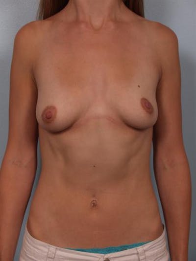Breast Augmentation Before & After Gallery - Patient 1310019 - Image 1