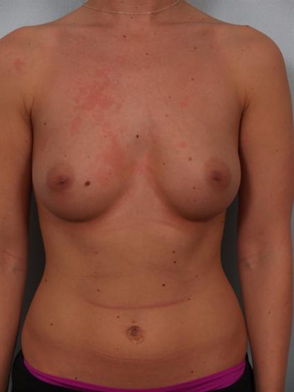 Breast Augmentation Before & After Gallery - Patient 1310021 - Image 1