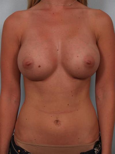 Breast Augmentation Before & After Gallery - Patient 1310021 - Image 2