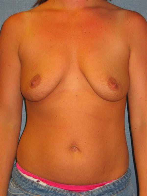 Breast Augmentation Before & After Gallery - Patient 1310022 - Image 3