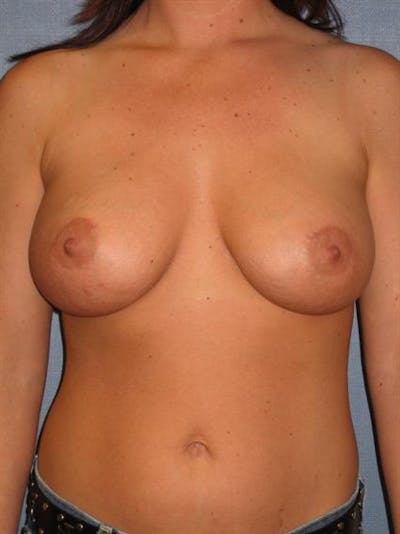 Breast Augmentation Before & After Gallery - Patient 1310022 - Image 4
