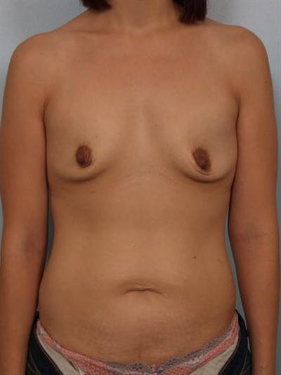 Breast Augmentation Before & After Gallery - Patient 1310023 - Image 1