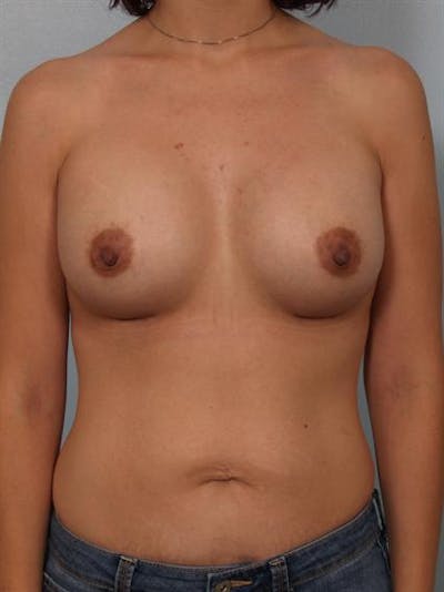 Breast Augmentation Before & After Gallery - Patient 1310023 - Image 2
