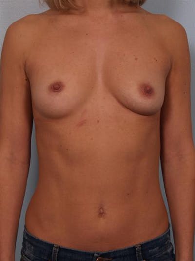 Breast Augmentation Before & After Gallery - Patient 1310024 - Image 1