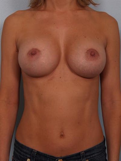 Breast Augmentation Before & After Gallery - Patient 1310024 - Image 2