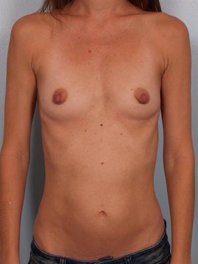 Breast Augmentation Before & After Gallery - Patient 1310025 - Image 1