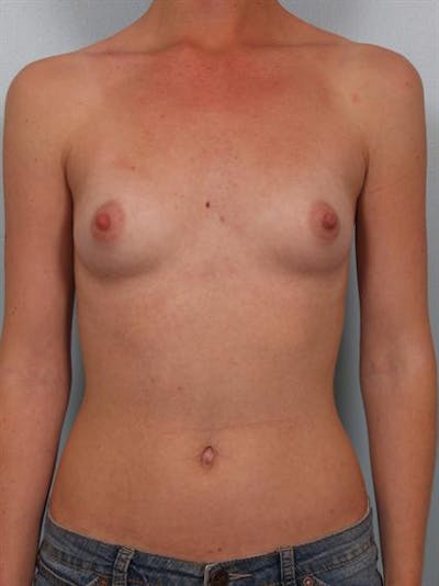 Breast Augmentation Before & After Gallery - Patient 1310027 - Image 1