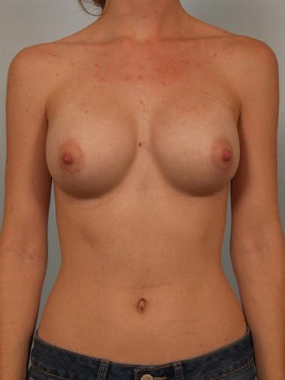 Breast Augmentation Before & After Gallery - Patient 1310027 - Image 2