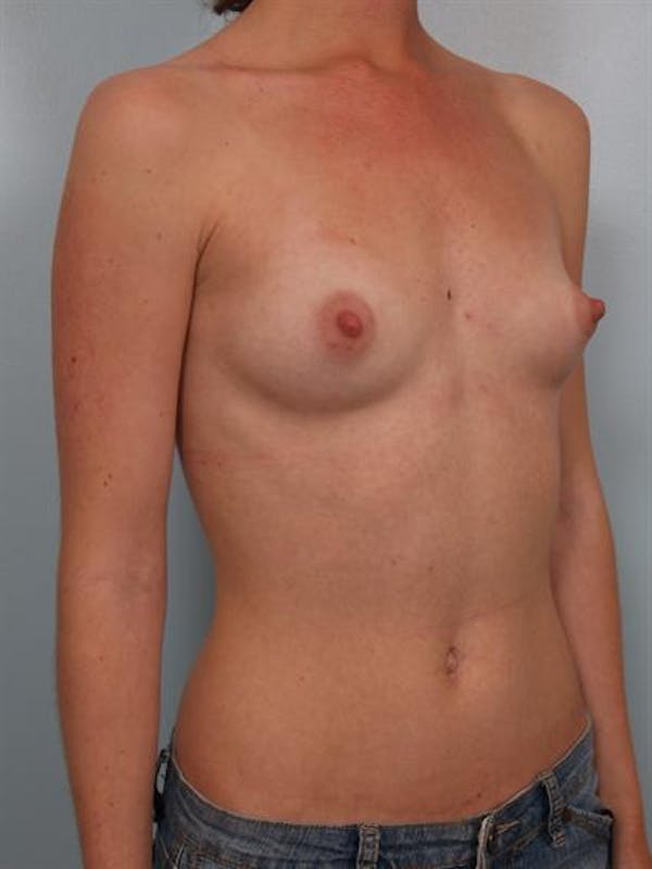 Breast Augmentation Before & After Gallery - Patient 1310027 - Image 3
