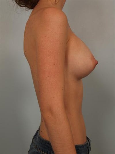 Breast Augmentation Before & After Gallery - Patient 1310027 - Image 6