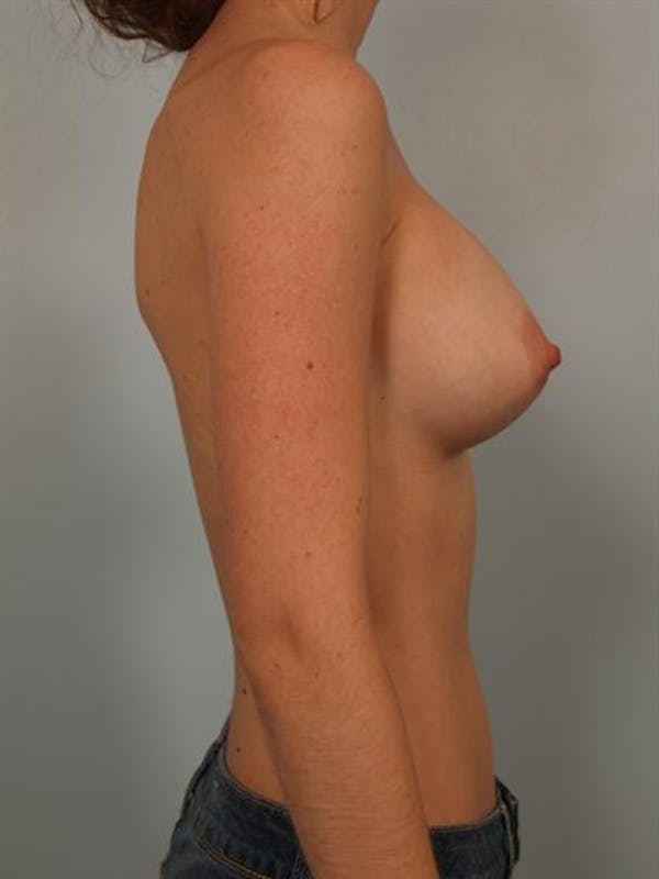 Breast Augmentation Before & After Gallery - Patient 1310027 - Image 6