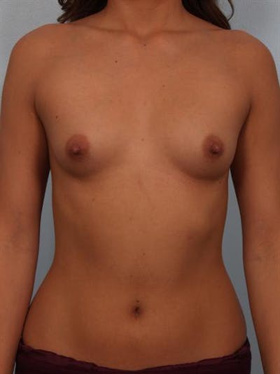 Breast Augmentation Before & After Gallery - Patient 1310029 - Image 1