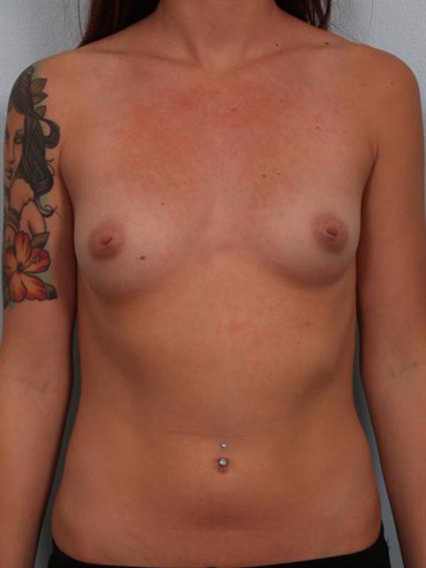 Breast Augmentation Before & After Gallery - Patient 1310030 - Image 1