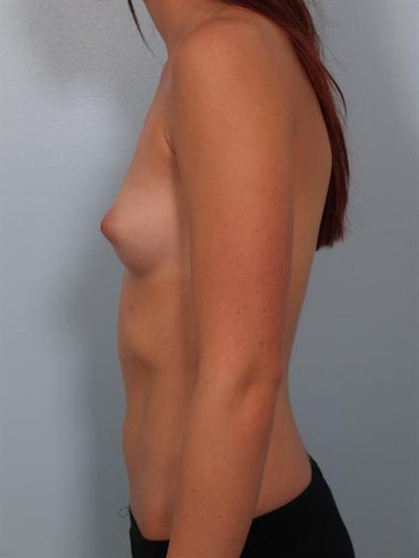 Breast Augmentation Before & After Gallery - Patient 1310030 - Image 3