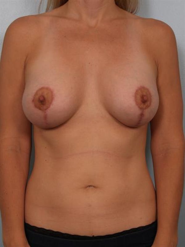 Breast Augmentation Gallery - Patient 1310032 - Image 4