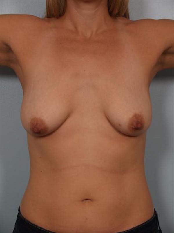 Breast Augmentation Before & After Gallery - Patient 1310032 - Image 5
