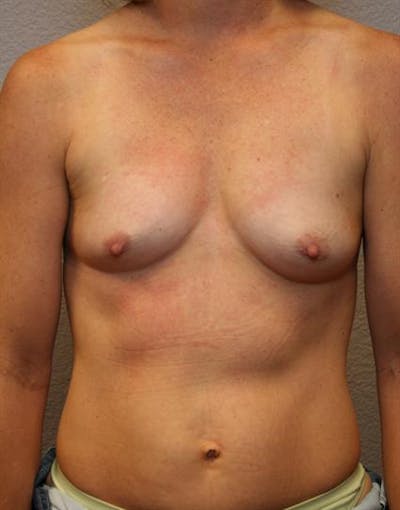 Breast Augmentation Before & After Gallery - Patient 1310033 - Image 1