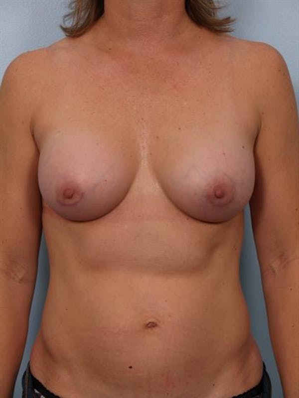 Breast Augmentation Before & After Gallery - Patient 1310033 - Image 2