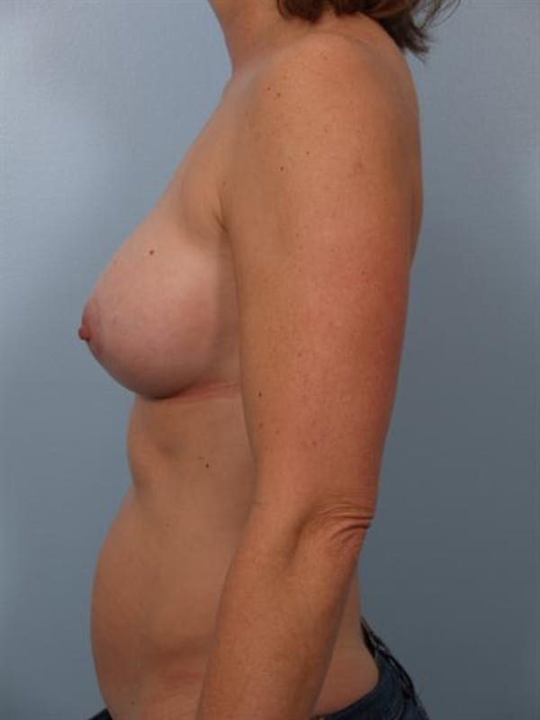 Breast Augmentation Before & After Gallery - Patient 1310033 - Image 4