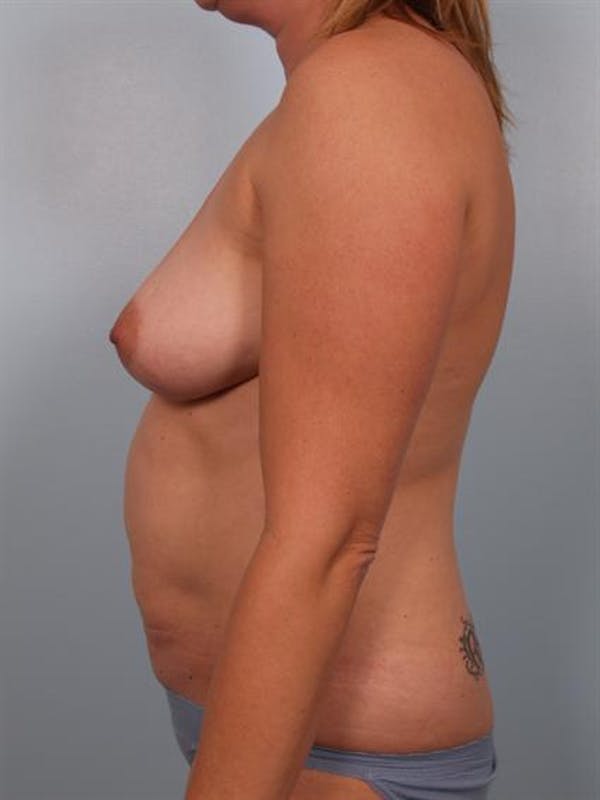 Breast Augmentation Before & After Gallery - Patient 1310035 - Image 3