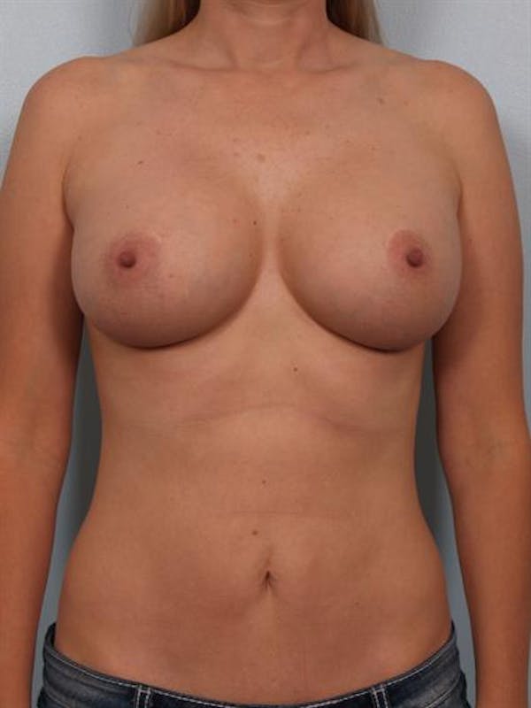 Breast Augmentation Before & After Gallery - Patient 1310224 - Image 4