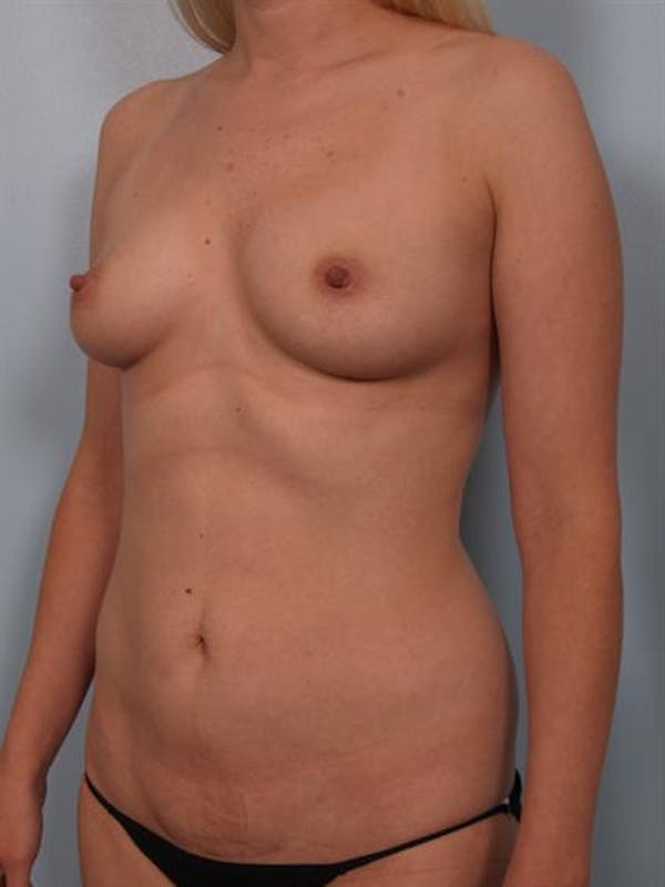 Breast Augmentation Before & After Gallery - Patient 1310224 - Image 5