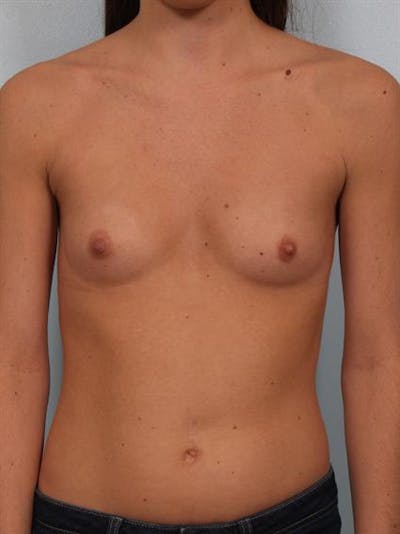 Breast Augmentation Before & After Gallery - Patient 1310226 - Image 1