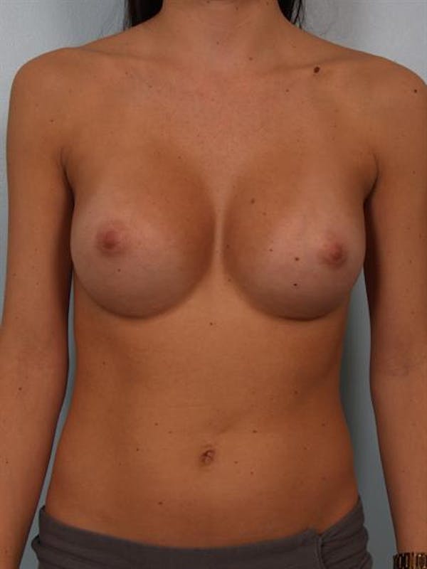 Breast Augmentation Before & After Gallery - Patient 1310226 - Image 2