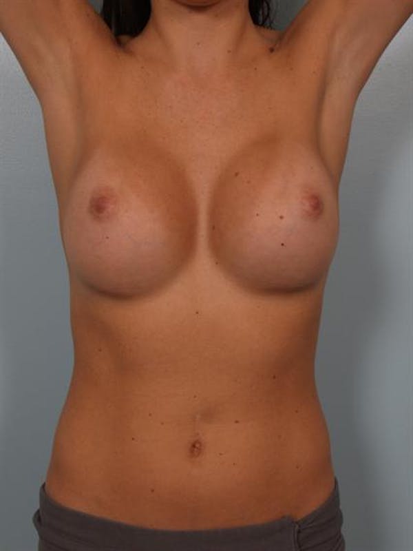 Breast Augmentation Before & After Gallery - Patient 1310226 - Image 6